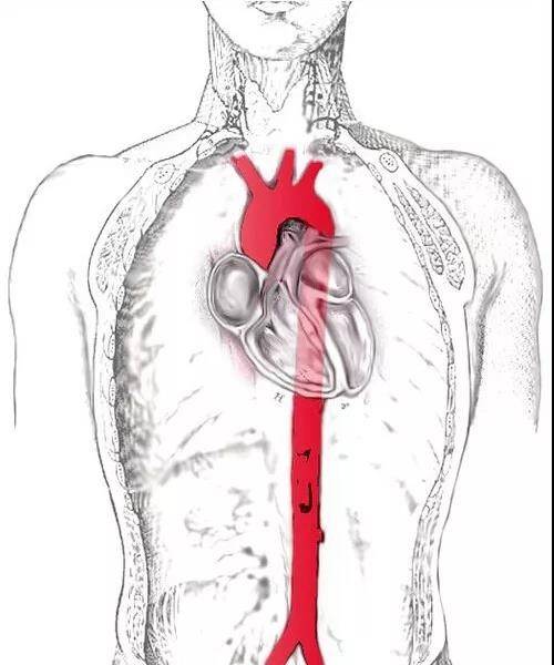 主动脉夹层,藏在动脉血管里的不定时炸弹_手机搜狐网