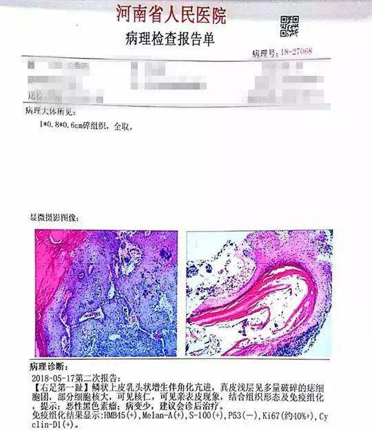 真菌感染?医生:恶性黑色素瘤病变