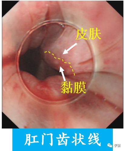 "内镜下内痔硬化治疗"学习笔记