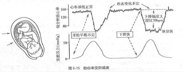 助产干货:胎心监护的观察和处理要点,附病例分析