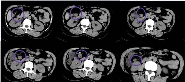 10幅图教你学会在ct片上找到阑尾!