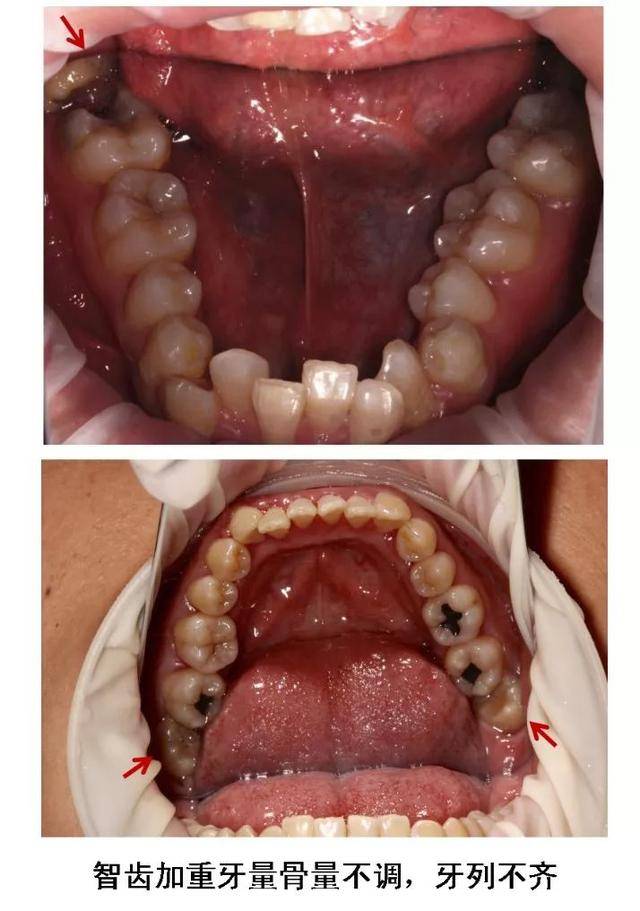 智齿因为长在最里面,平时刷牙时容易被忽视,也很难清洁到位,经常会