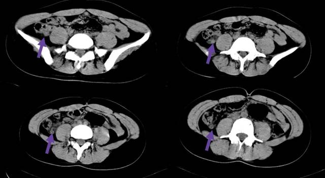 10幅图教你学会在ct片上找到阑尾!