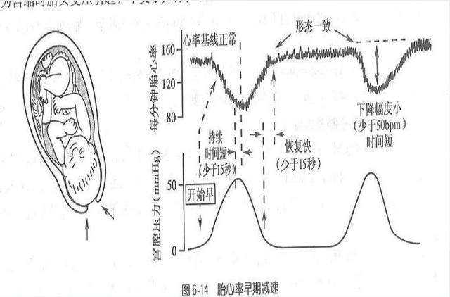助产干货:胎心监护的观察和处理要点,附病例分析