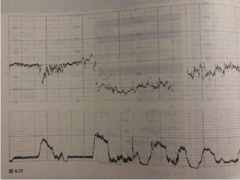 前面的变异减速 可能有脐带受压,导致胎儿缺氧.