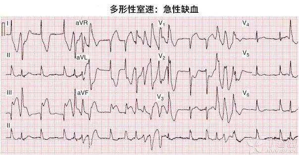 多形性室性心动过速心电图 编辑:江一 房室室速心房间期房性