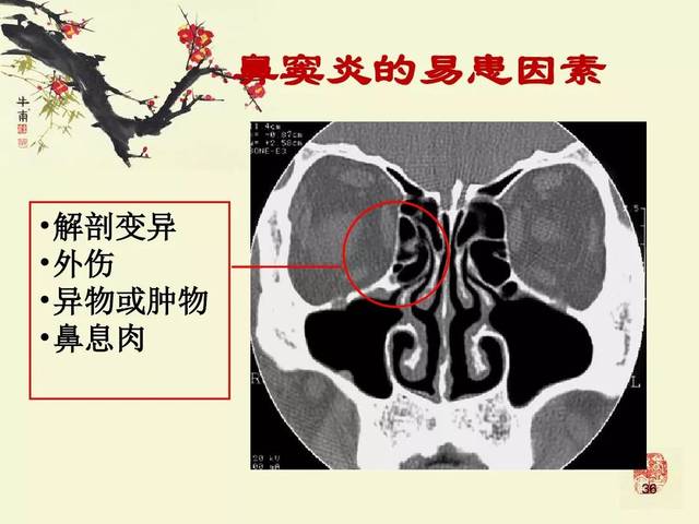 鼻,鼻窦炎的影像学表现