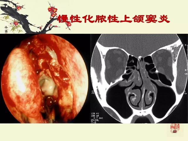 鼻,鼻窦炎的影像学表现