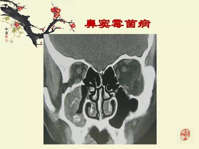 鼻,鼻窦炎的影像学表现