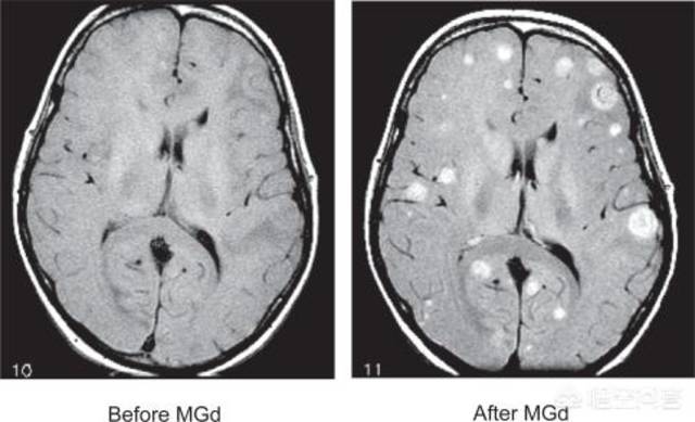 肺结节手术为什么要做脑部加强CT?