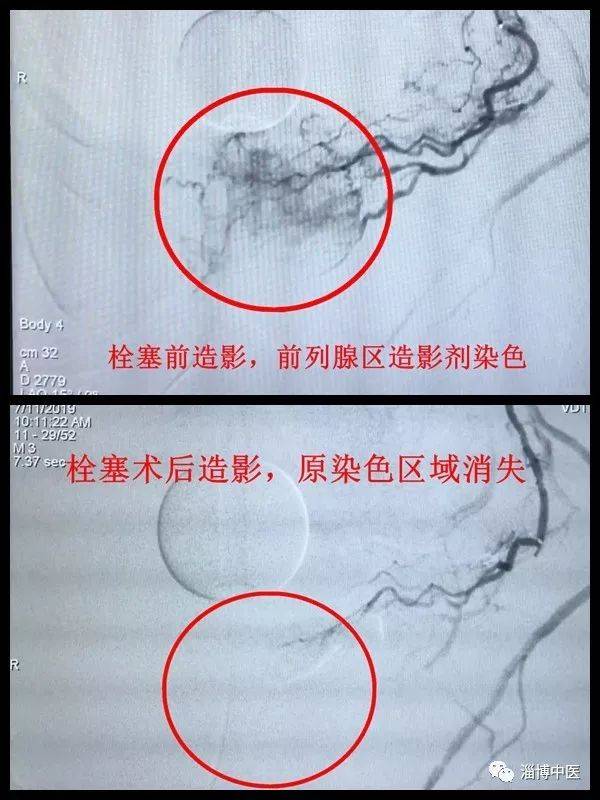 淄博市中医医院介入科开展前列腺动脉栓塞术治疗前列腺增生多例