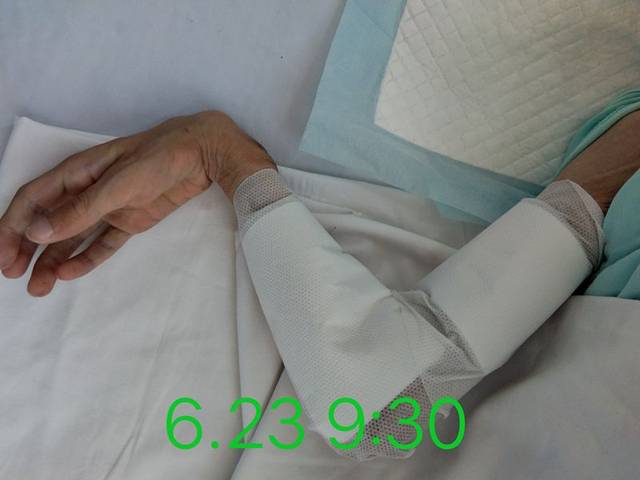 3.第三天查看患者,皮温正常,水肿较前减轻,患者哭闹次数减少.
