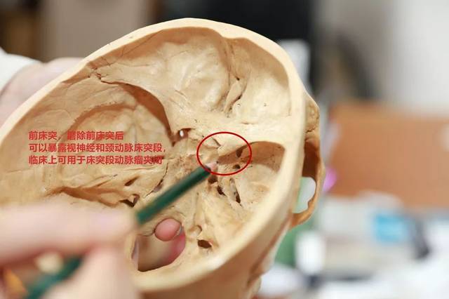 刚才提到的高速磨钻就常被用于脑部手术,比如图中所示的 前床突和内听
