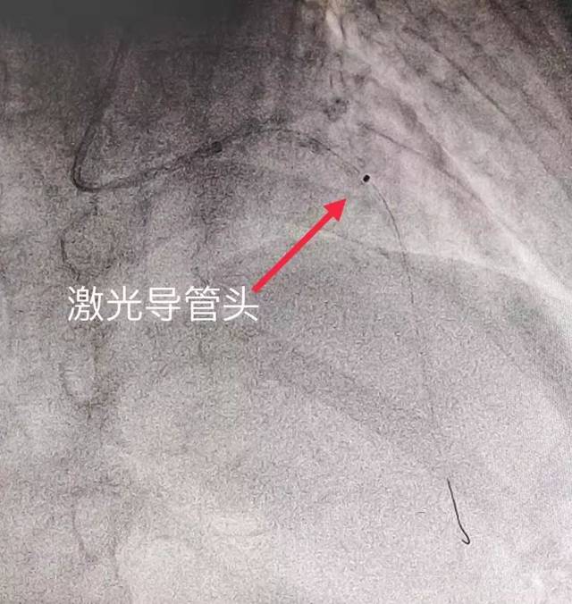 再狭窄"准分子激光冠脉内斑块消蚀术"