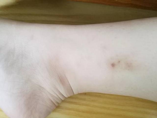 喜艾堂提醒:灸出水泡居然还是好现象?先分清灸花和烫伤!