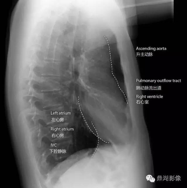 x线高清图谱 | 胸片详细诊断要点