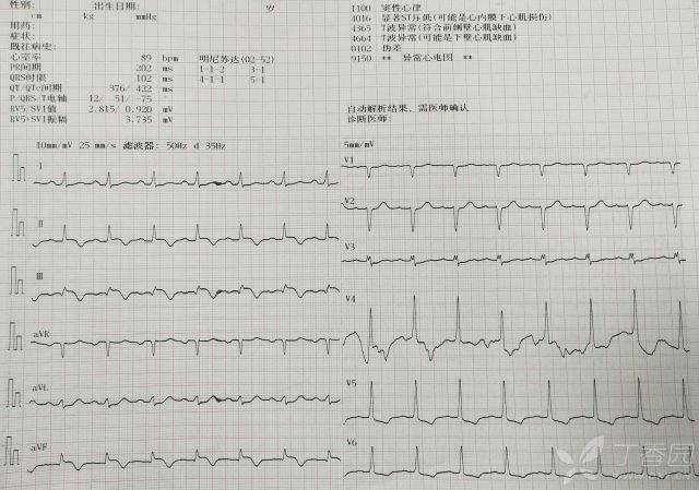 夜班惊魂:我经历的 2 次室颤,6 次复律