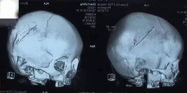 "患儿头皮撕脱伤,颅骨粉碎性骨折及硬膜下血肿,情况非常危险,必须立即