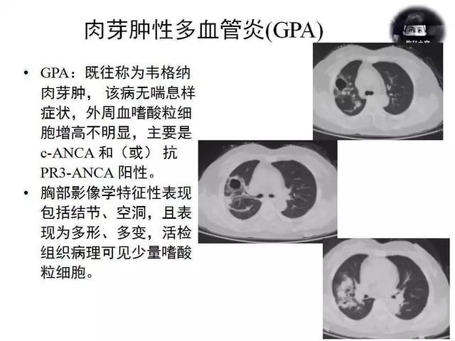 238期轮值病例:嗜酸性肉芽肿性多血管炎