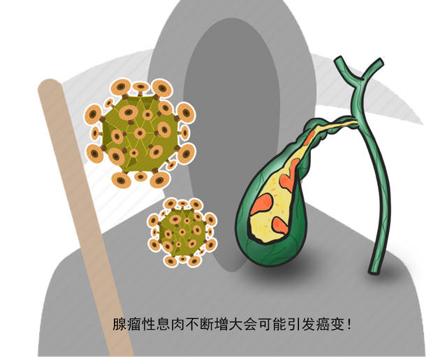 查出胆囊息肉需要切除?医生:视情况而定!