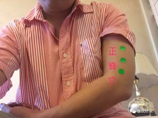 林正泰董氏针灸之闪腰处方穴分享