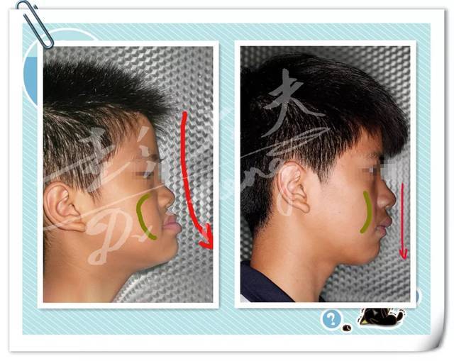 下图为两个病例治疗前后脸型和牙齿的变化,留意上下唇前后位置的变化