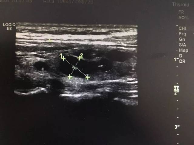 此图为甲状腺潴留囊肿超声图