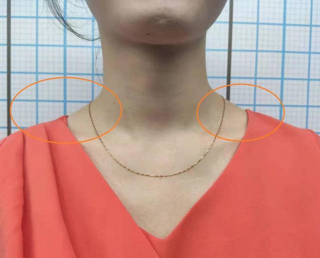 体态训练一女生如何减斜方肌