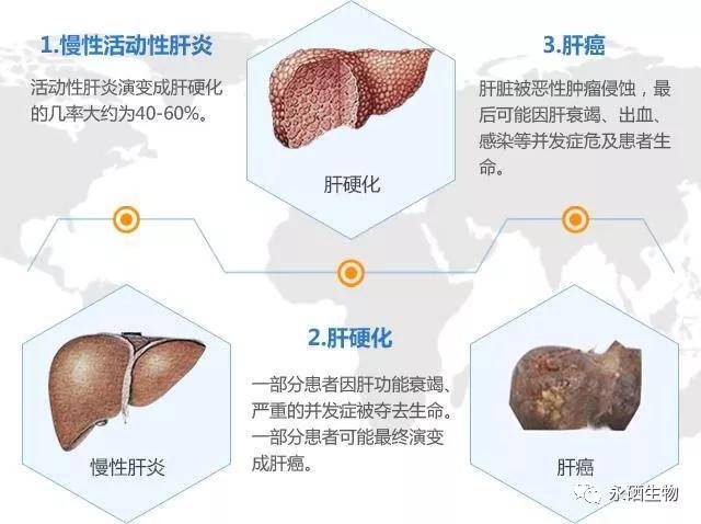 补硒对肝炎,肝硬化,肝癌的防治效果显著