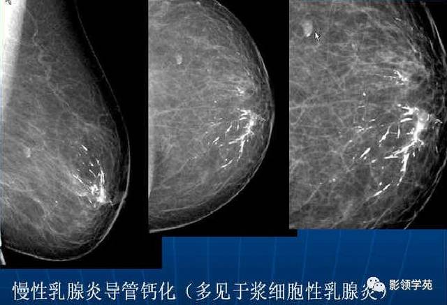 乳腺钙化的鉴别诊断与分级