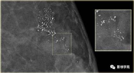 乳腺钙化的鉴别诊断与分级