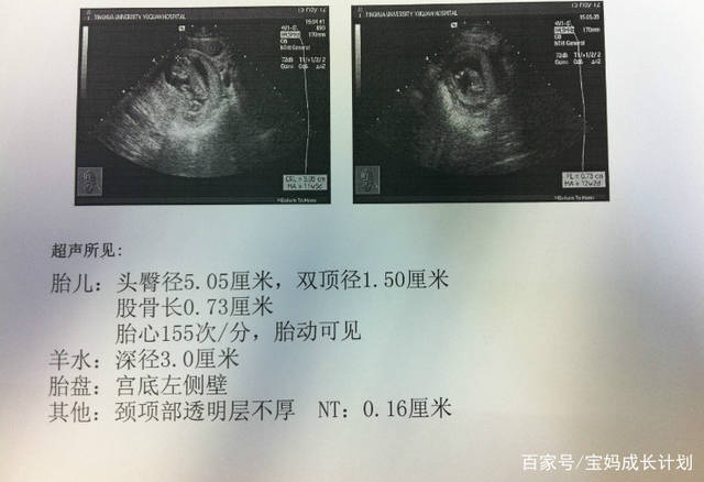孕早期B超单上的这两个数据,暗示了胎儿小秘