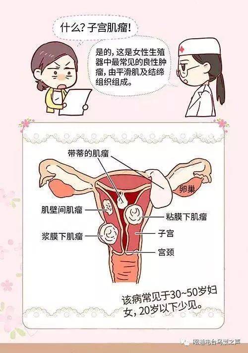 《祝您健康》你了解子宫肌瘤吗?昭通市第二人民医院方禄梅医生告诉你