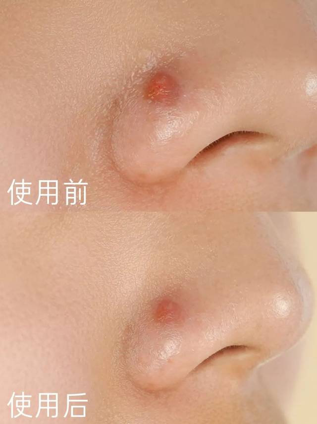 揭秘|刷酸后的自救流程,你都知道吗?