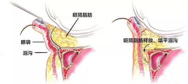 但是这个项目 对眼部要求比较高哦,脂肪的质量和肌肤的紧致度都有要求