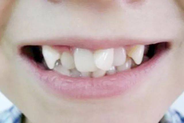 北大口腔周彦恒教授:7岁左右是第一个牙齿