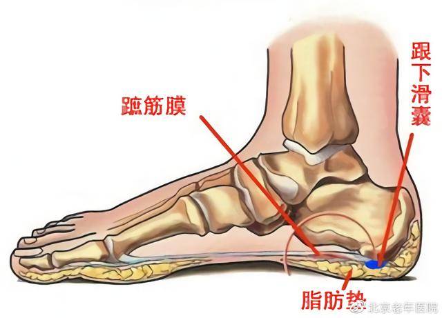 足跟痛的黑锅不能全让骨刺来背,揪出幕后的真正元凶