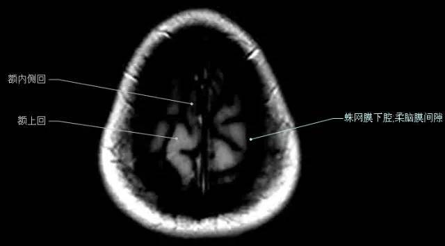 神经解剖| 头颅mr轴位解剖图