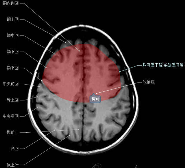神经解剖 头颅mr轴位解剖图