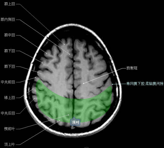 神经解剖| 头颅mr轴位解剖图