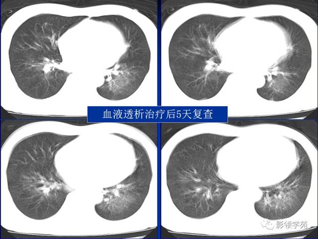 不同类型肺水肿的ct表现