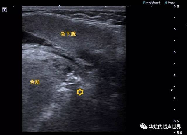 超声基础解剖:扁桃体的超声解剖