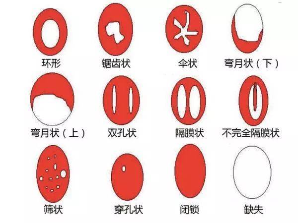 课堂 处女膜是阴道外口的一层中心有孔的薄膜 具有弹性 有不同的形状