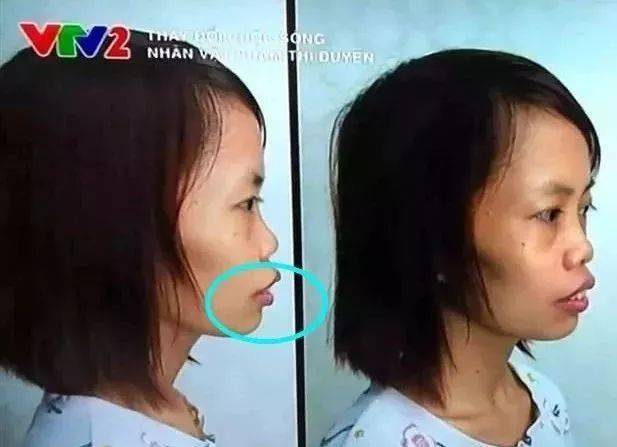 泰国丑女换头后逆袭成高圆圆,还找了个巨帅的老外男朋友?