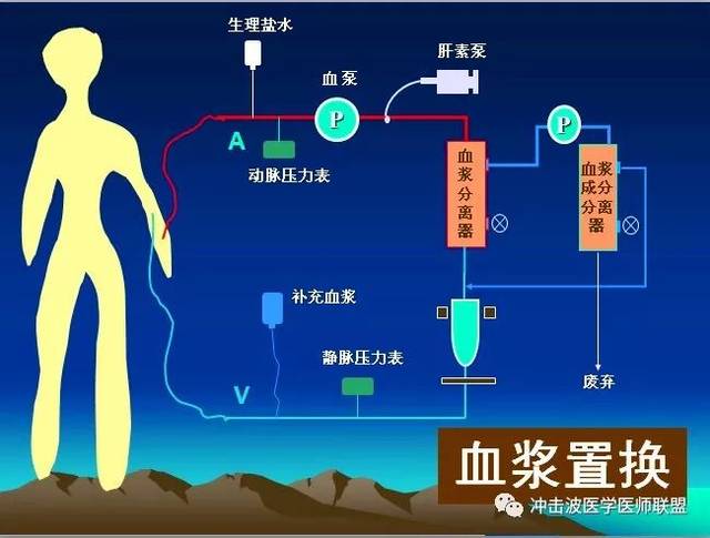 血液透析,血浆置换,血液透析,血液灌流,血浆置换?