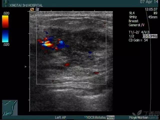 左侧乳腺可见一低回声实性结节,内部可见多发细小点状强回声,探头
