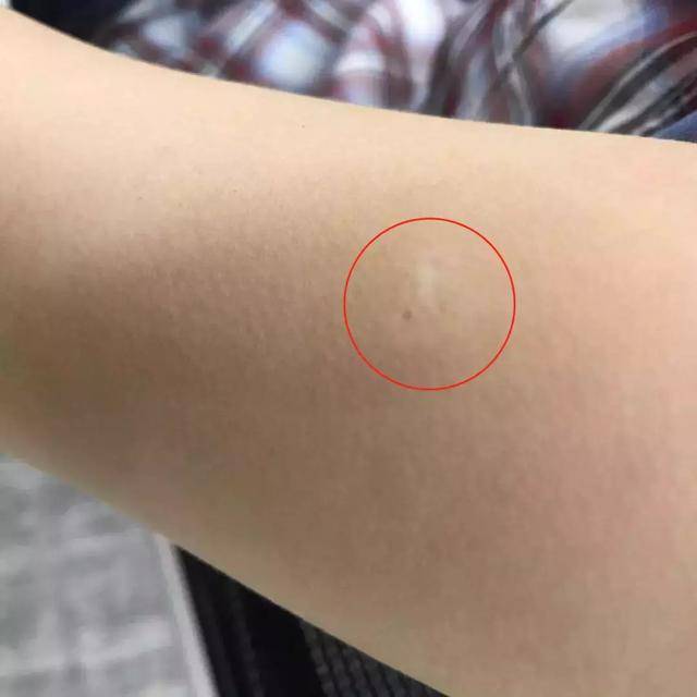 你手臂上有这种疤吗那是疫苗留下来的功勋章