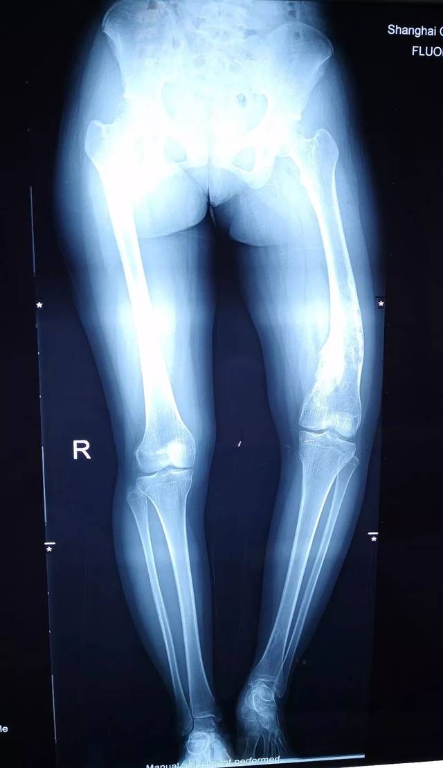新华医院骨科应用ct三维重建加3d打印技术成功为左下肢病理性短缩畸形