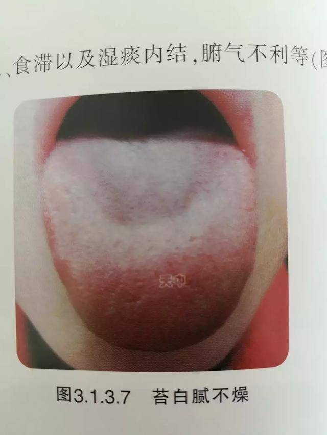 舌象之腐苔,6种状态带你全面了解何谓腐苔