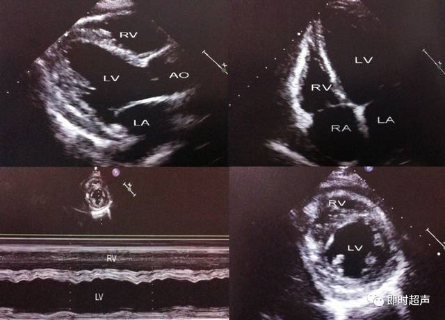 限制型心肌病与缩窄性心包炎的超声鉴别